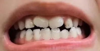孩子换牙,两颗门牙长成了 八字型 怎么办